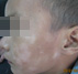 广东中研白癜风